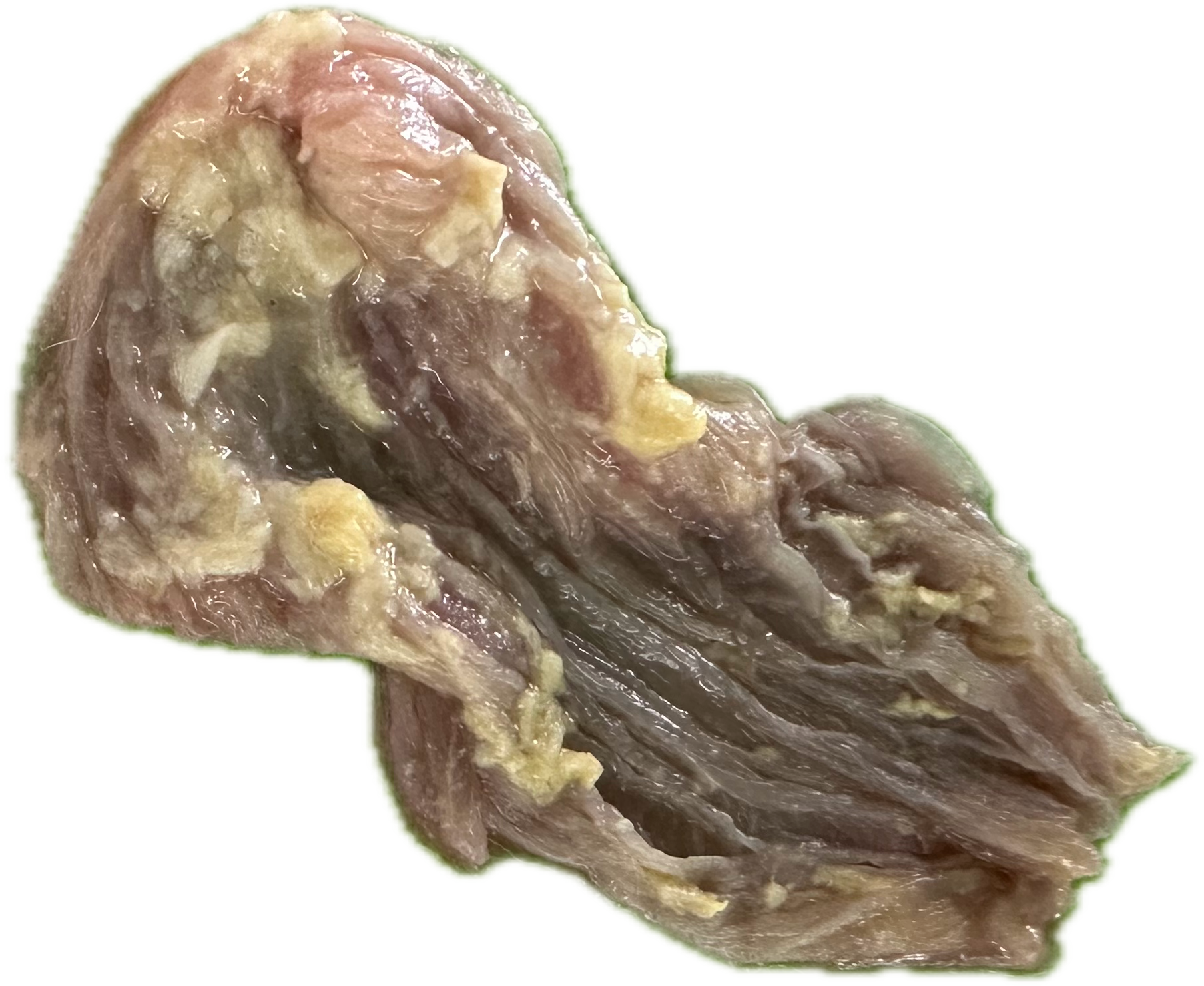 Patología Gástrica 30