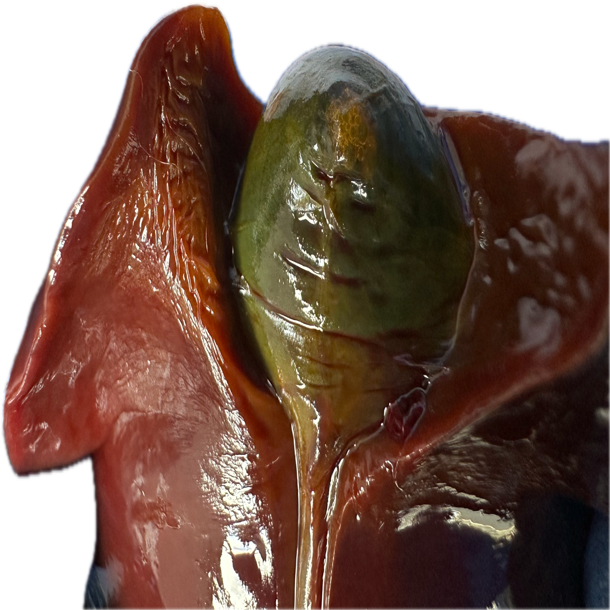 Patología Hepática 1