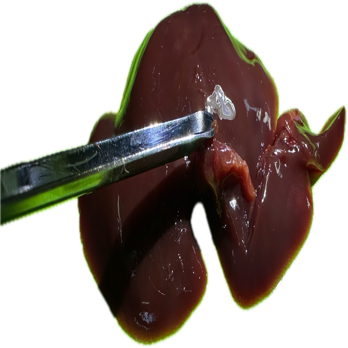 Patología Hepática 12