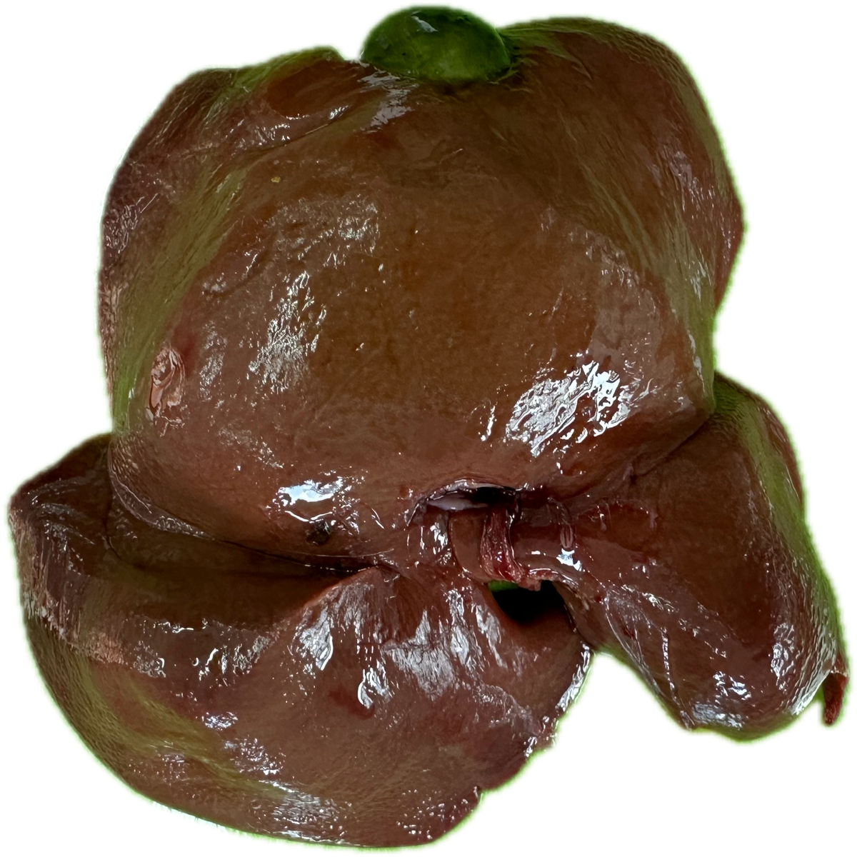 Patología Hepática 15