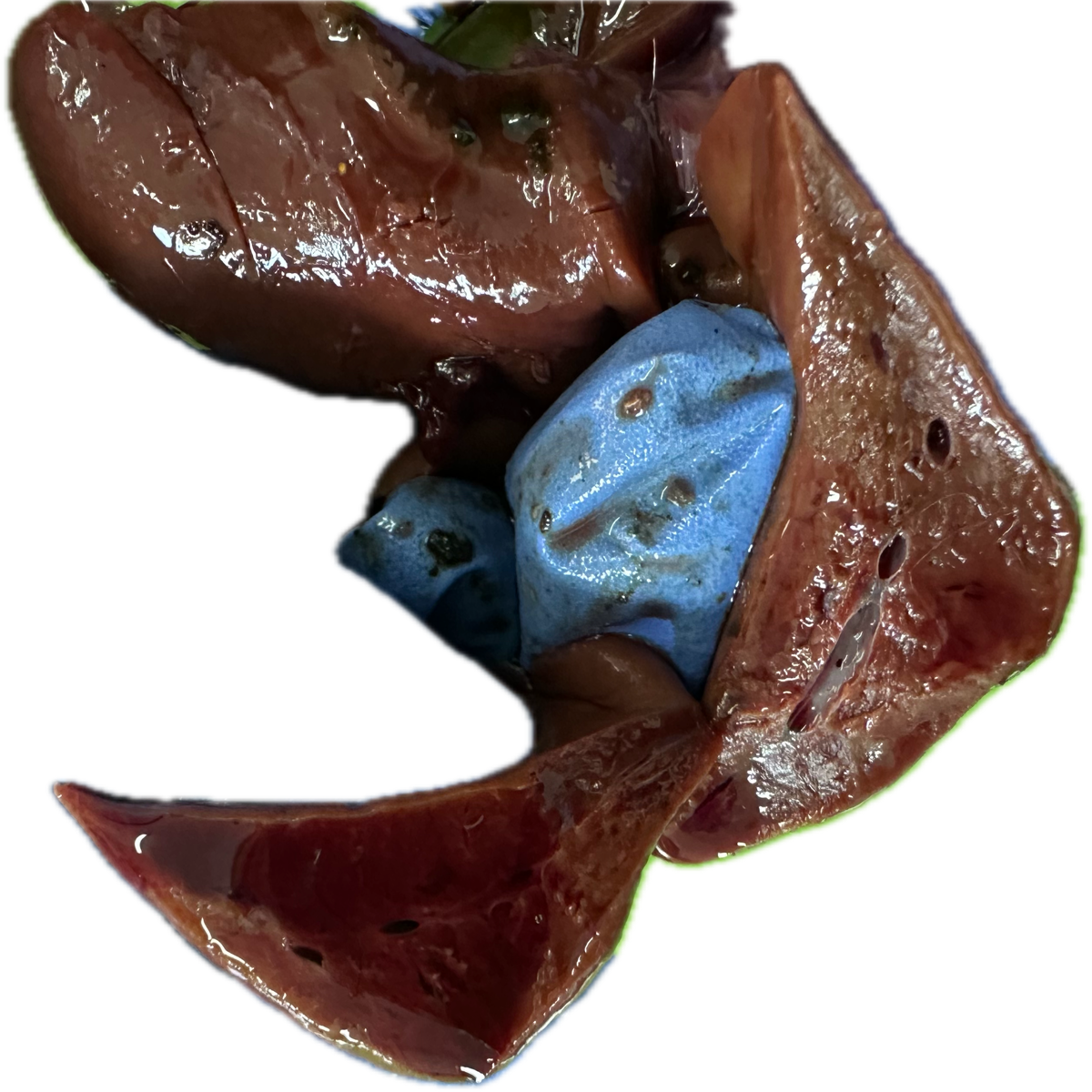 Patología Hepática 16