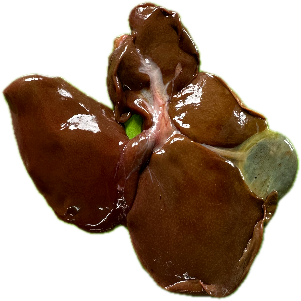 Patología Hepática 17