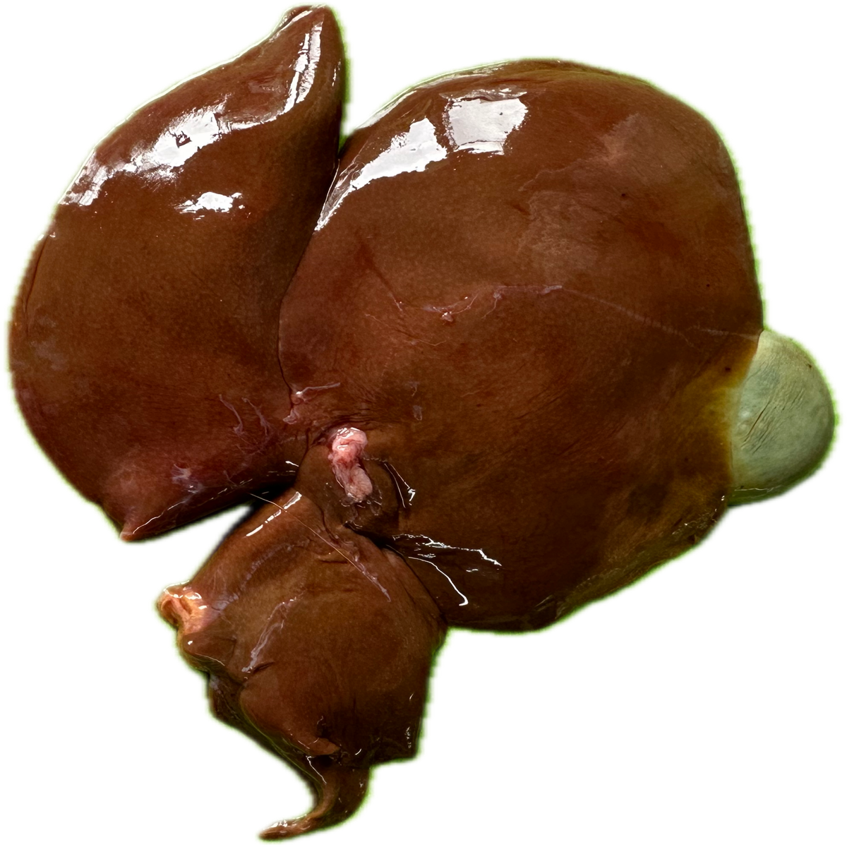 Patología Hepática 18