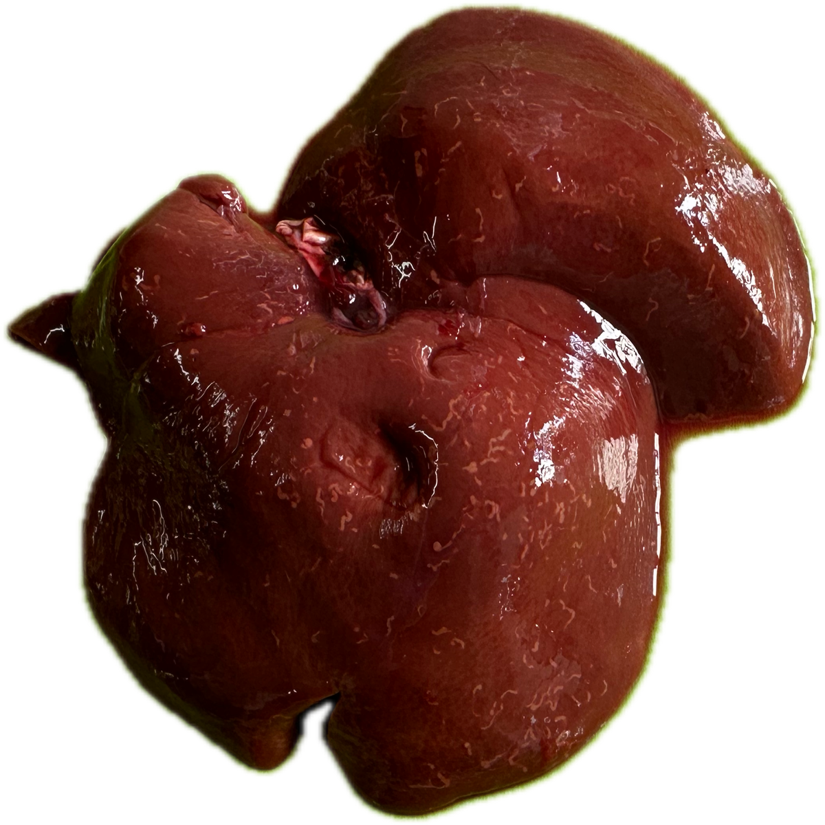 Patología Hepática 20