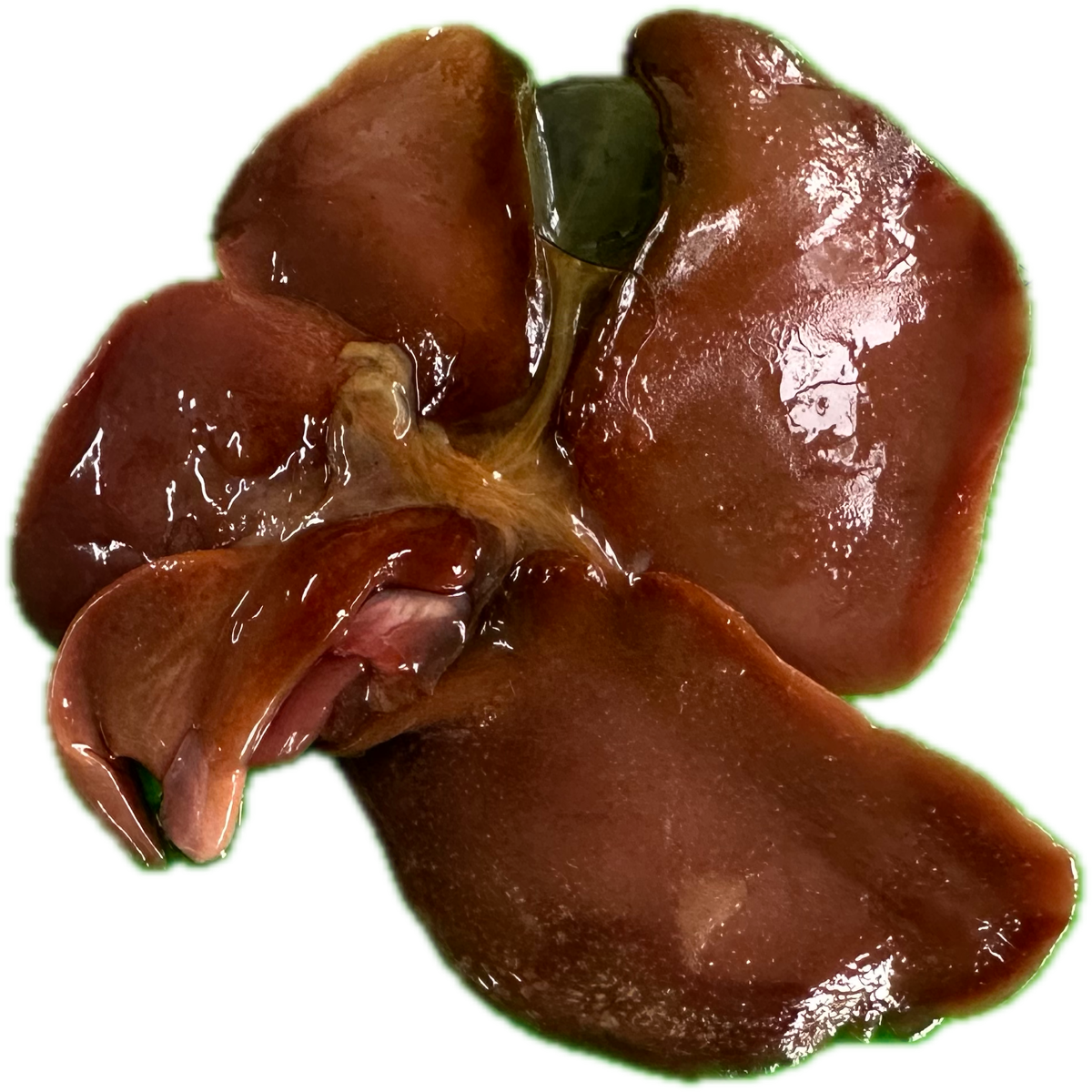 Patología Hepática 24