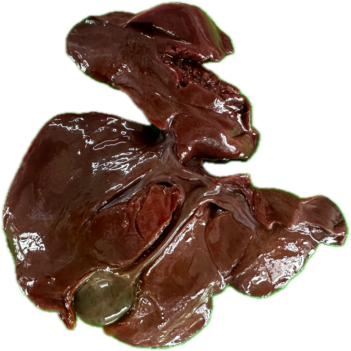 Patología Hepática 25