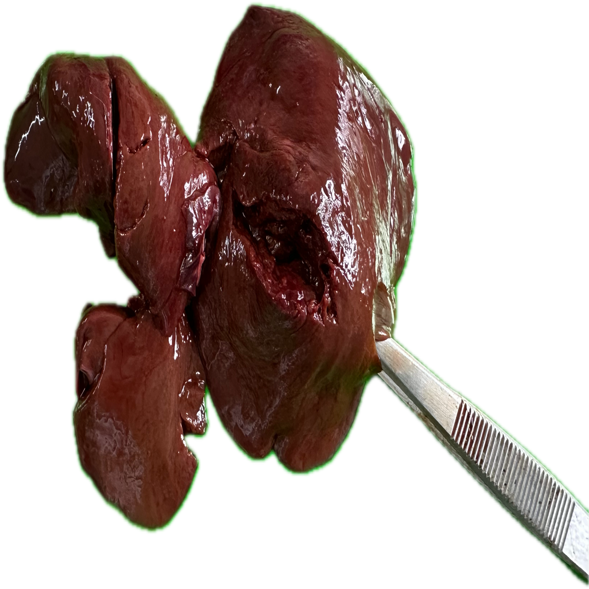 Patología Hepática 26