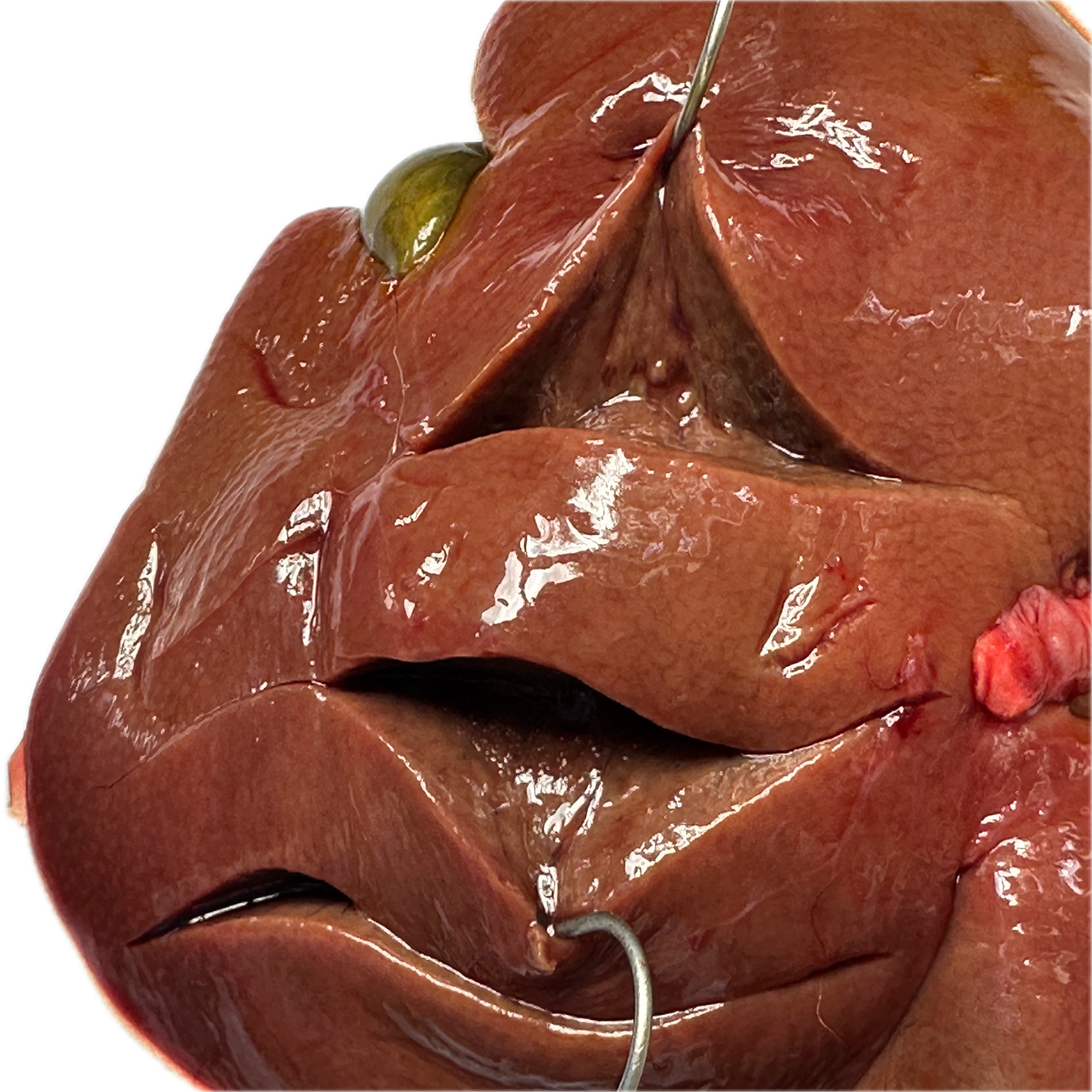 Patología Hepática 4