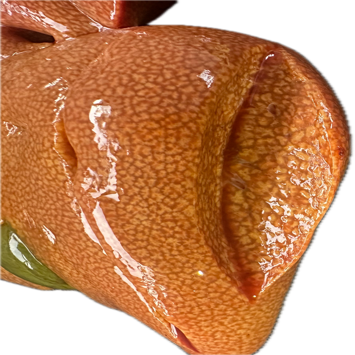 Patología Hepática 5