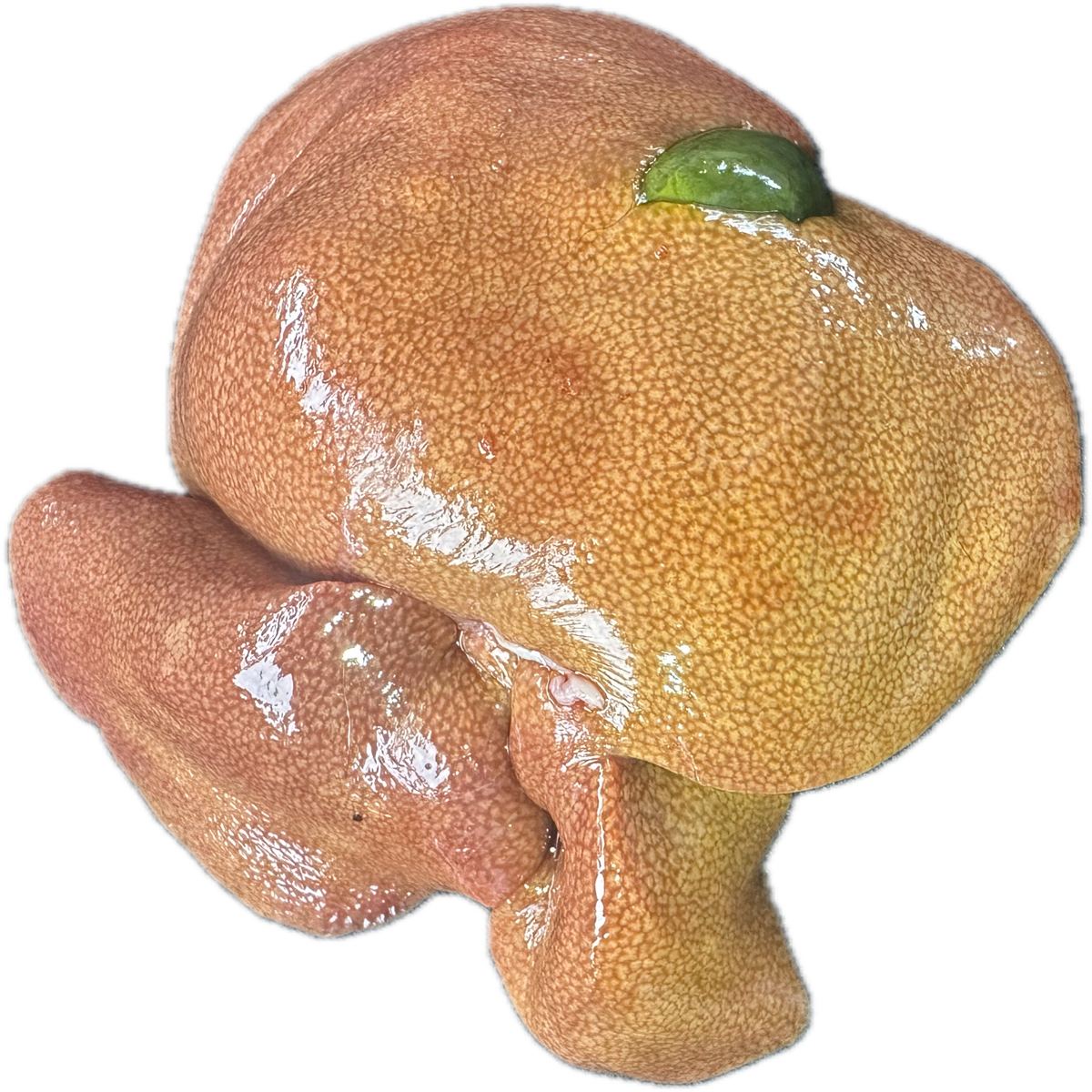 Patología Hepática 6
