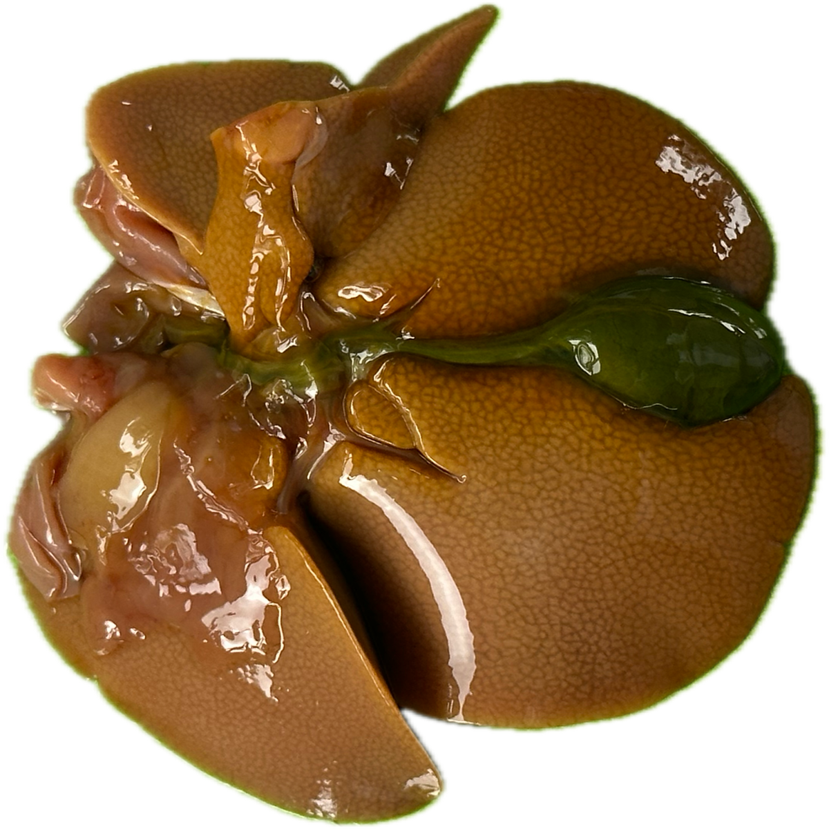 Patología Hepática 8