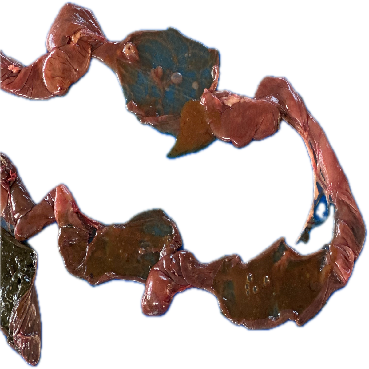 Patología Intestinal 1