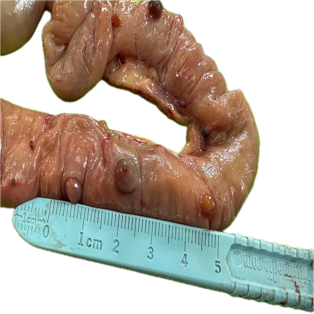 Patología Intestinal 8