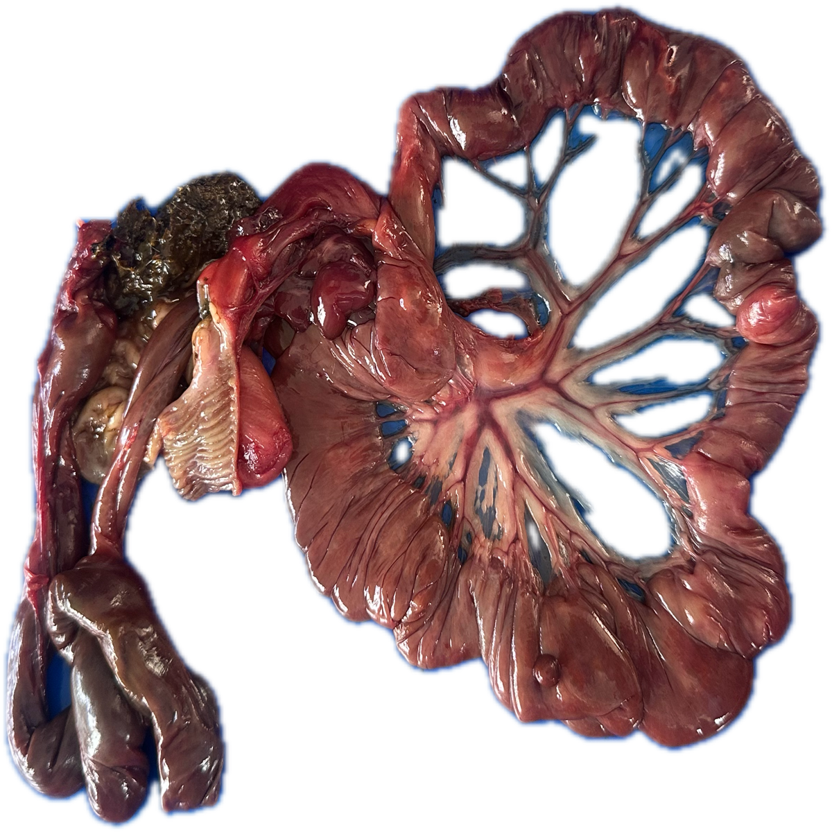 Patología Intestinal 2