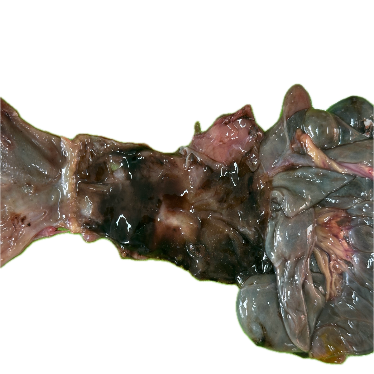 Patología Intestinal 11