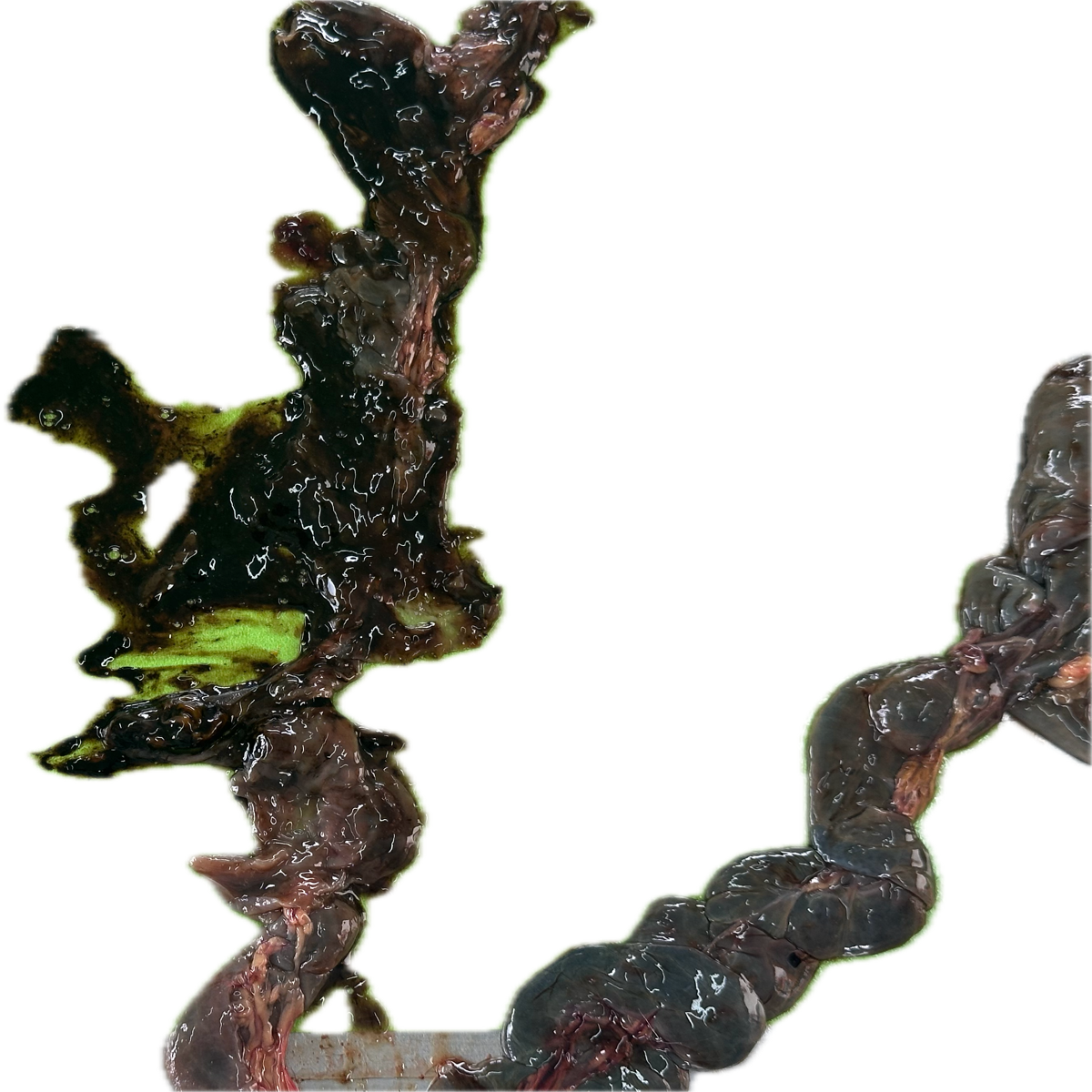 Patología Intestinal 12