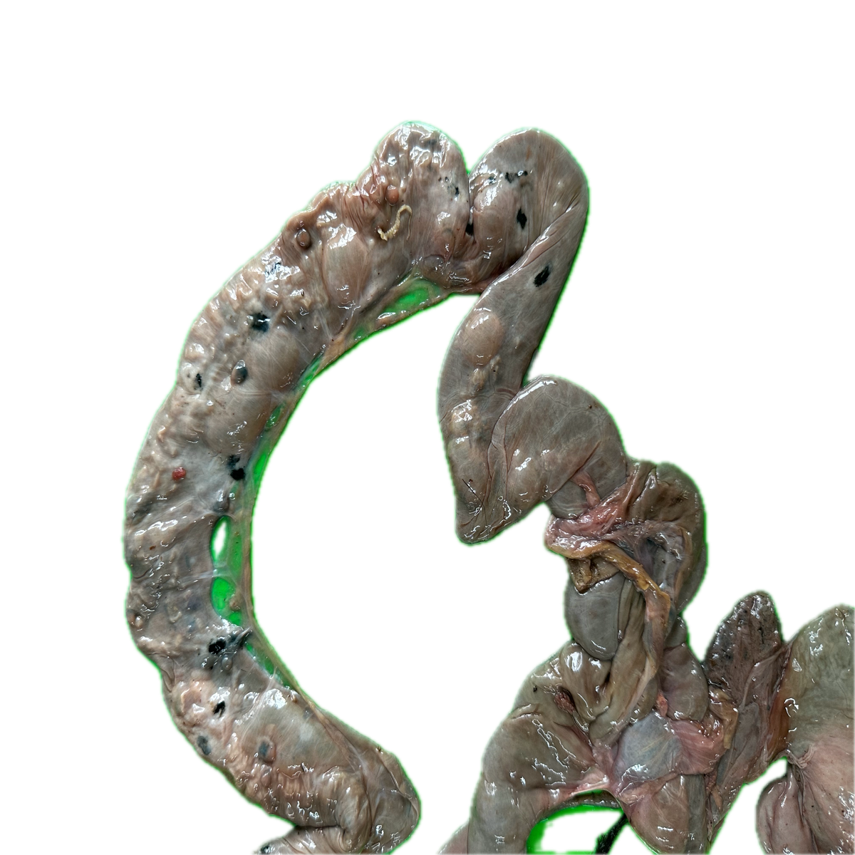 Patología Intestinal 13