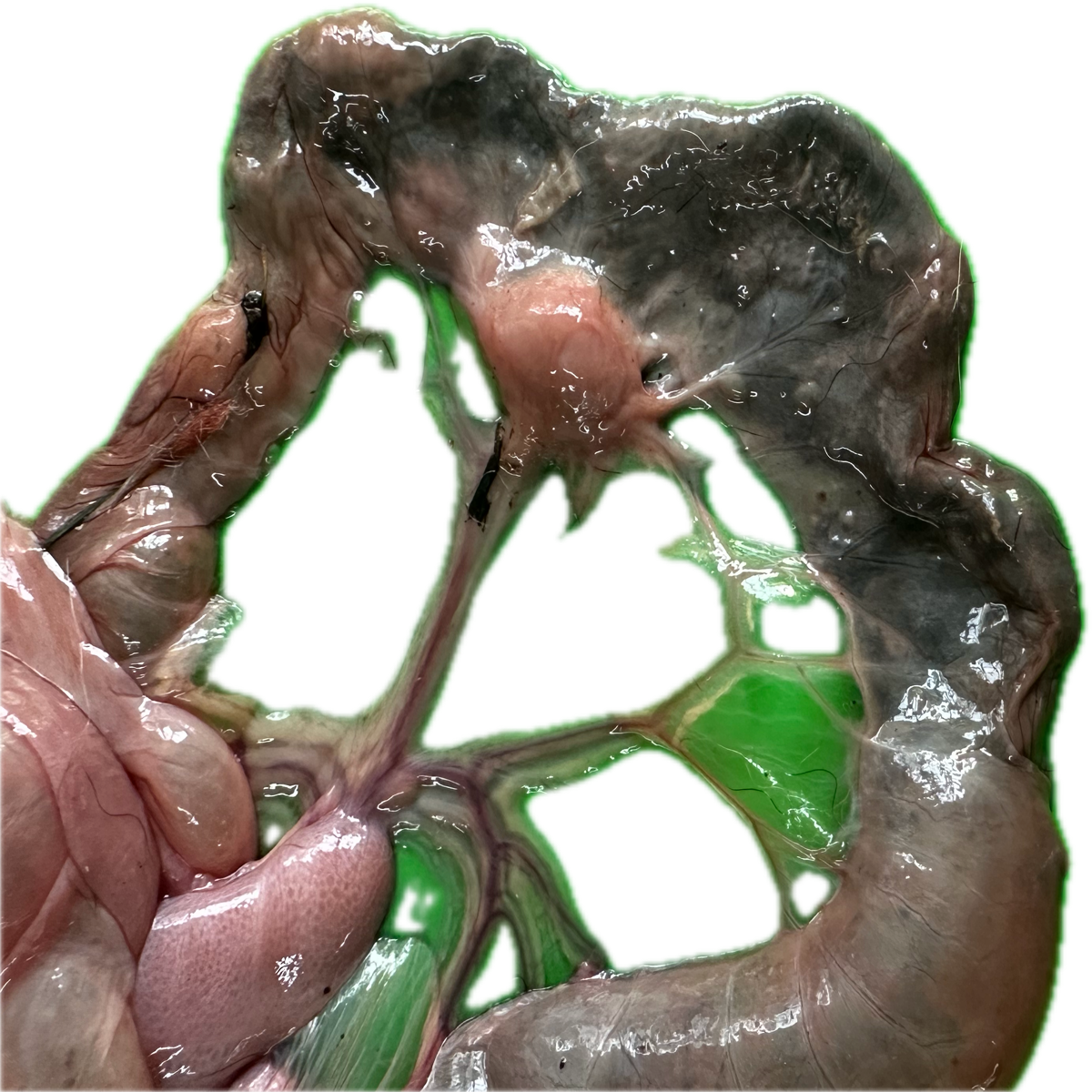 Patología Intestinal 14