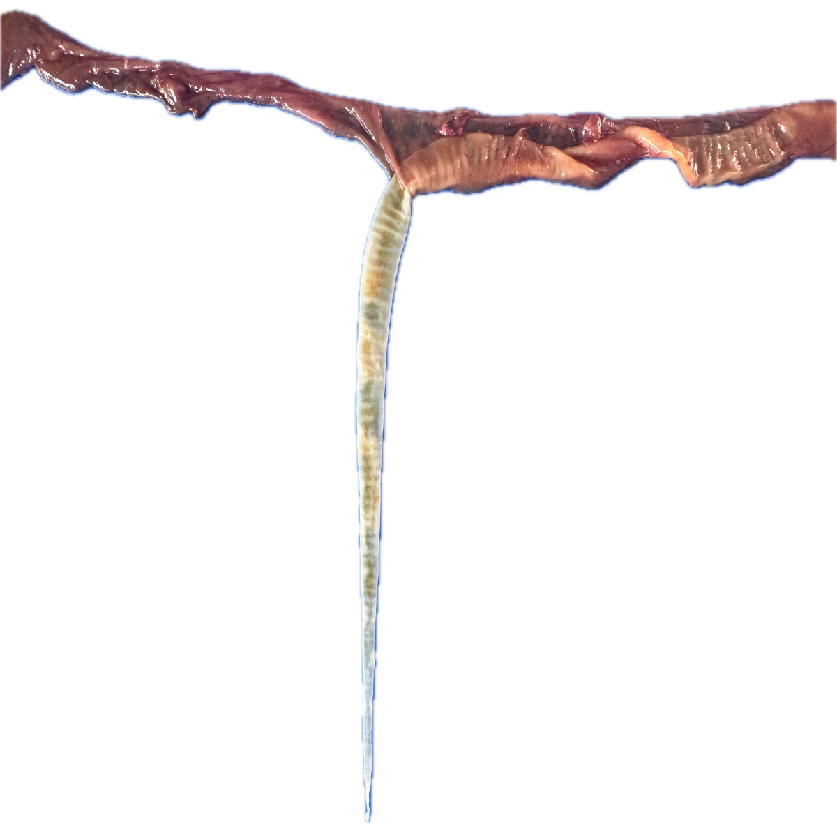 Patología Intestinal 3