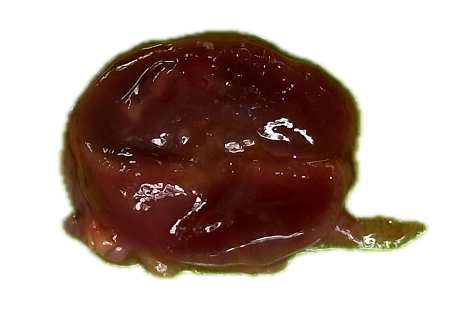 Patología Glandular 14