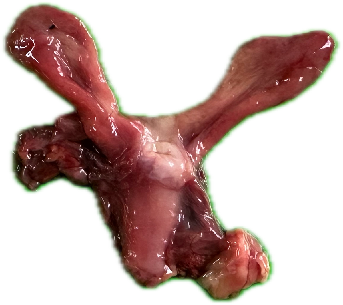 Patología Ovaria 2