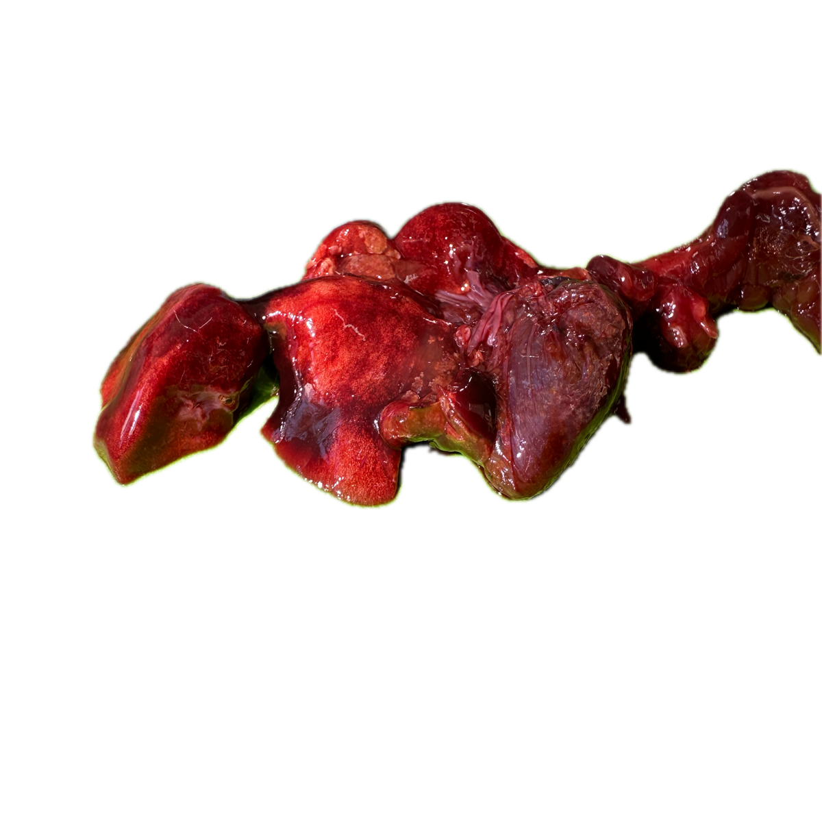 Patología Pulmonar 8