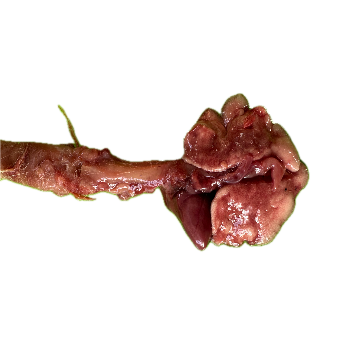 Patología Pulmonar 10