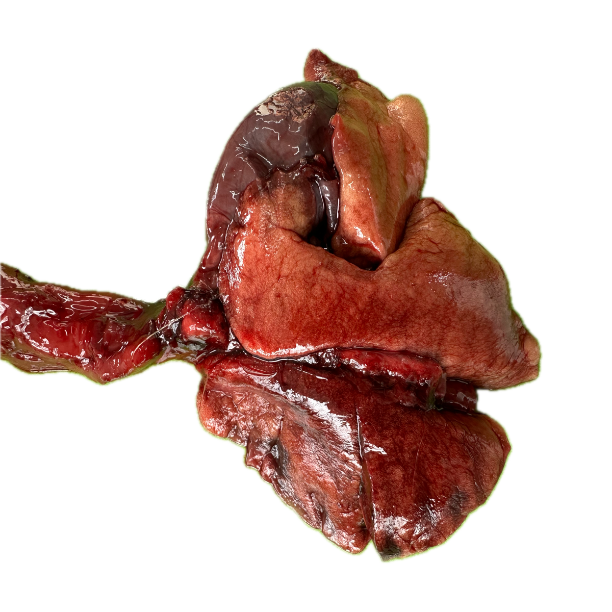 Patología Pulmonar 11