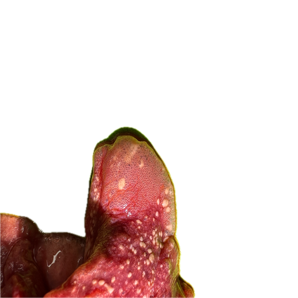Patología Pulmonar 12