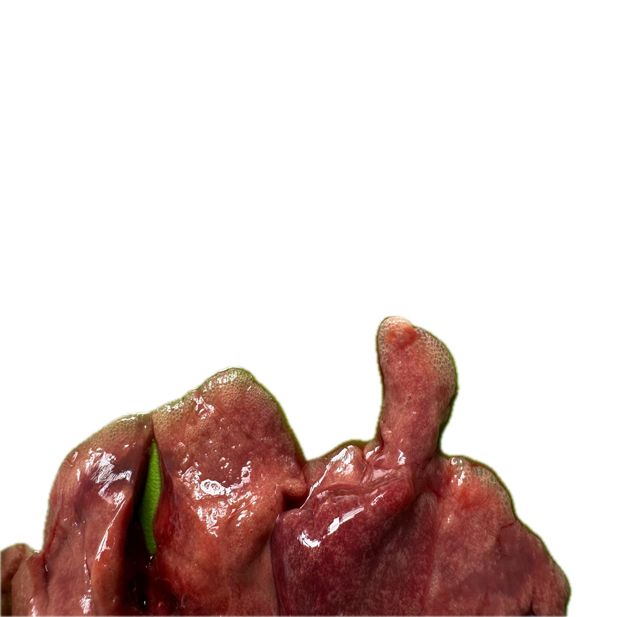 Patología Pulmonar 13