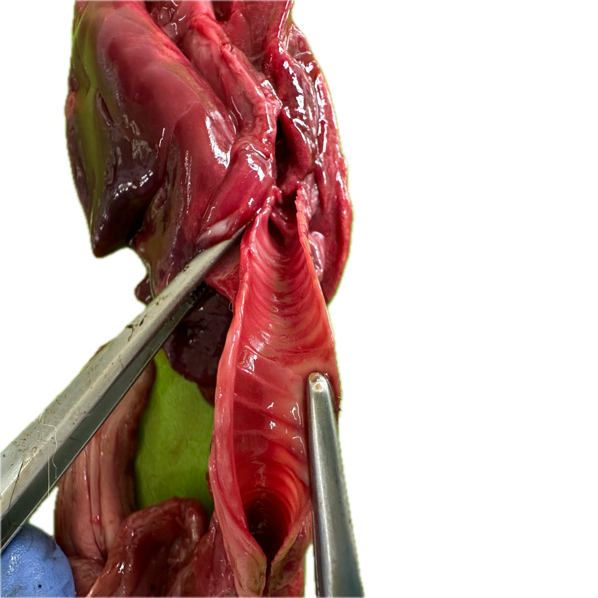 Patología Pulmonar 14