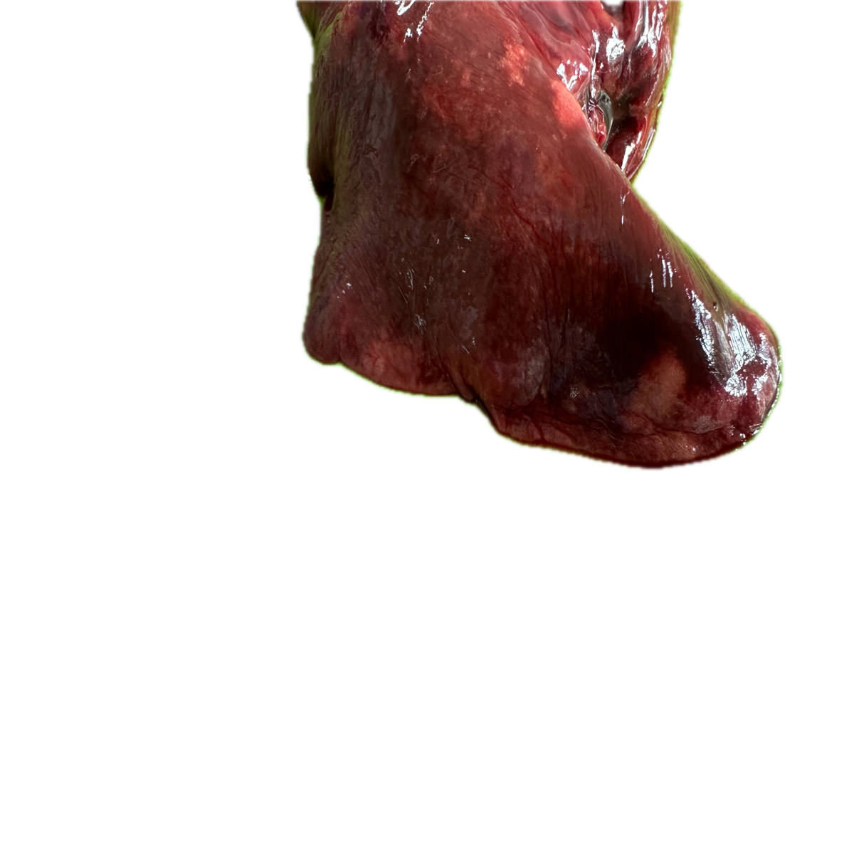 Patología Pulmonar 15
