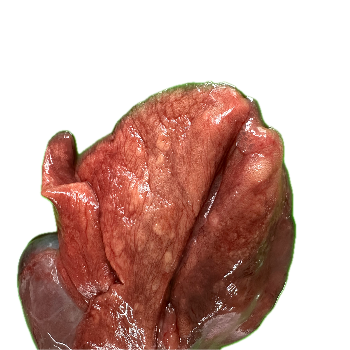Patología Pulmonar 16