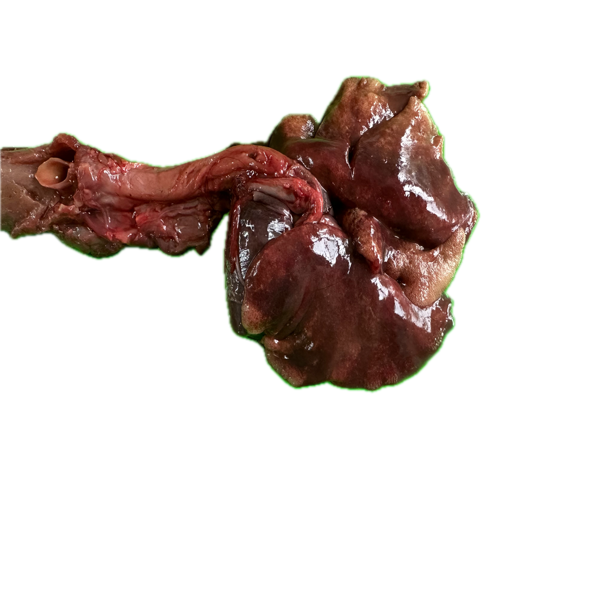 Patología Pulmonar 17