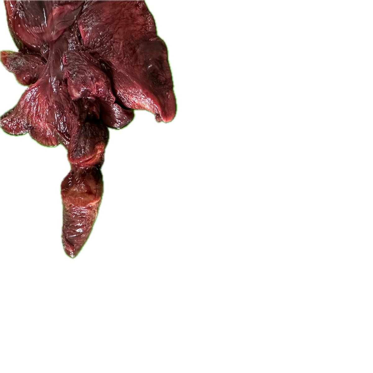 Patología Pulmonar 20