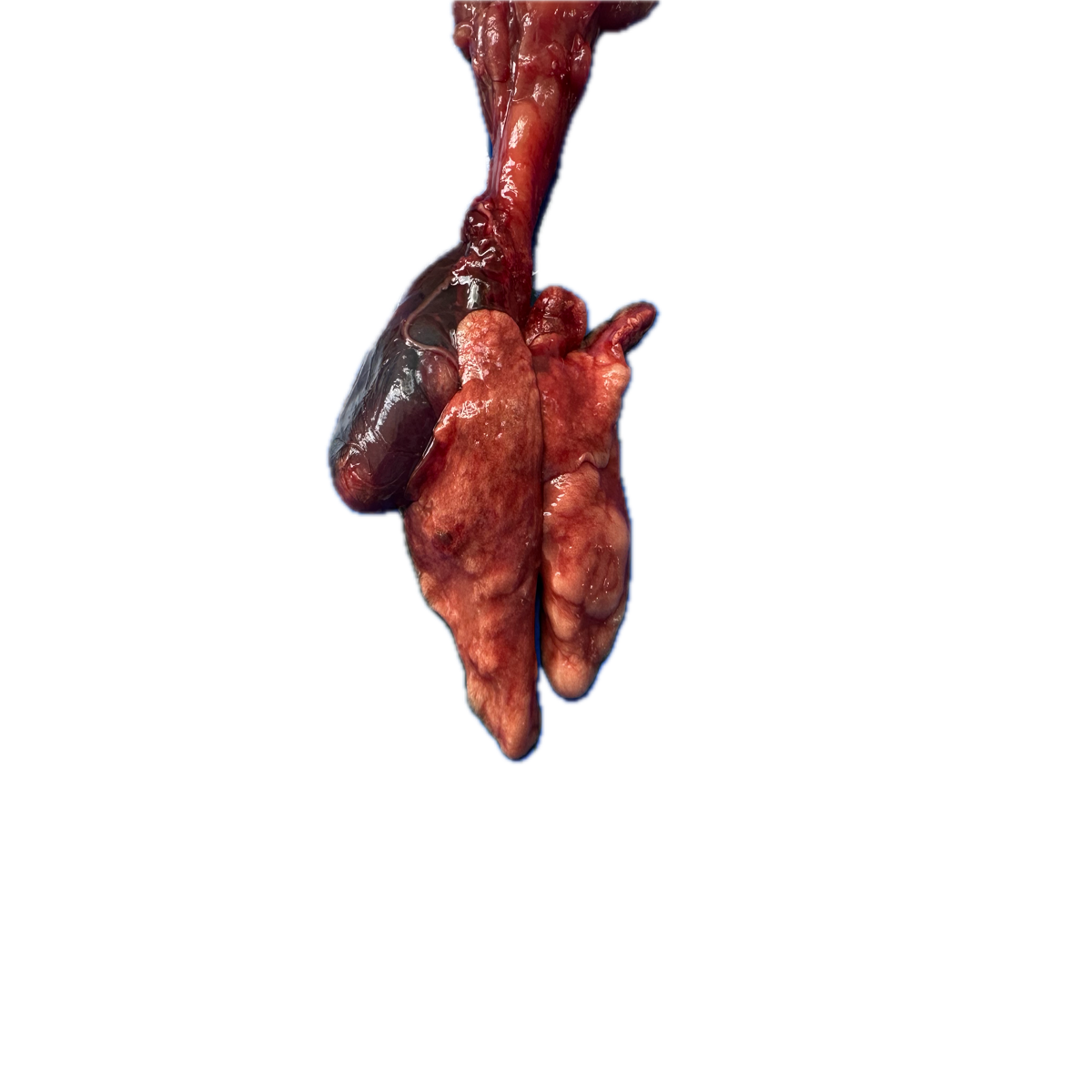 Patología Pulmonar 3