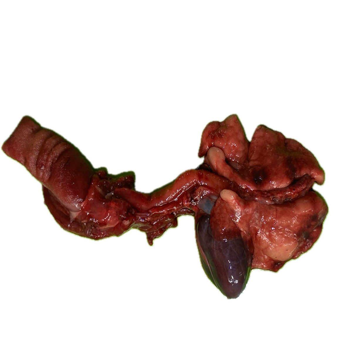 Patología Pulmonar 5