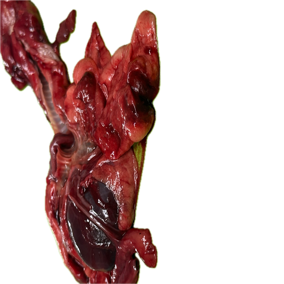 Patología Pulmonar 6