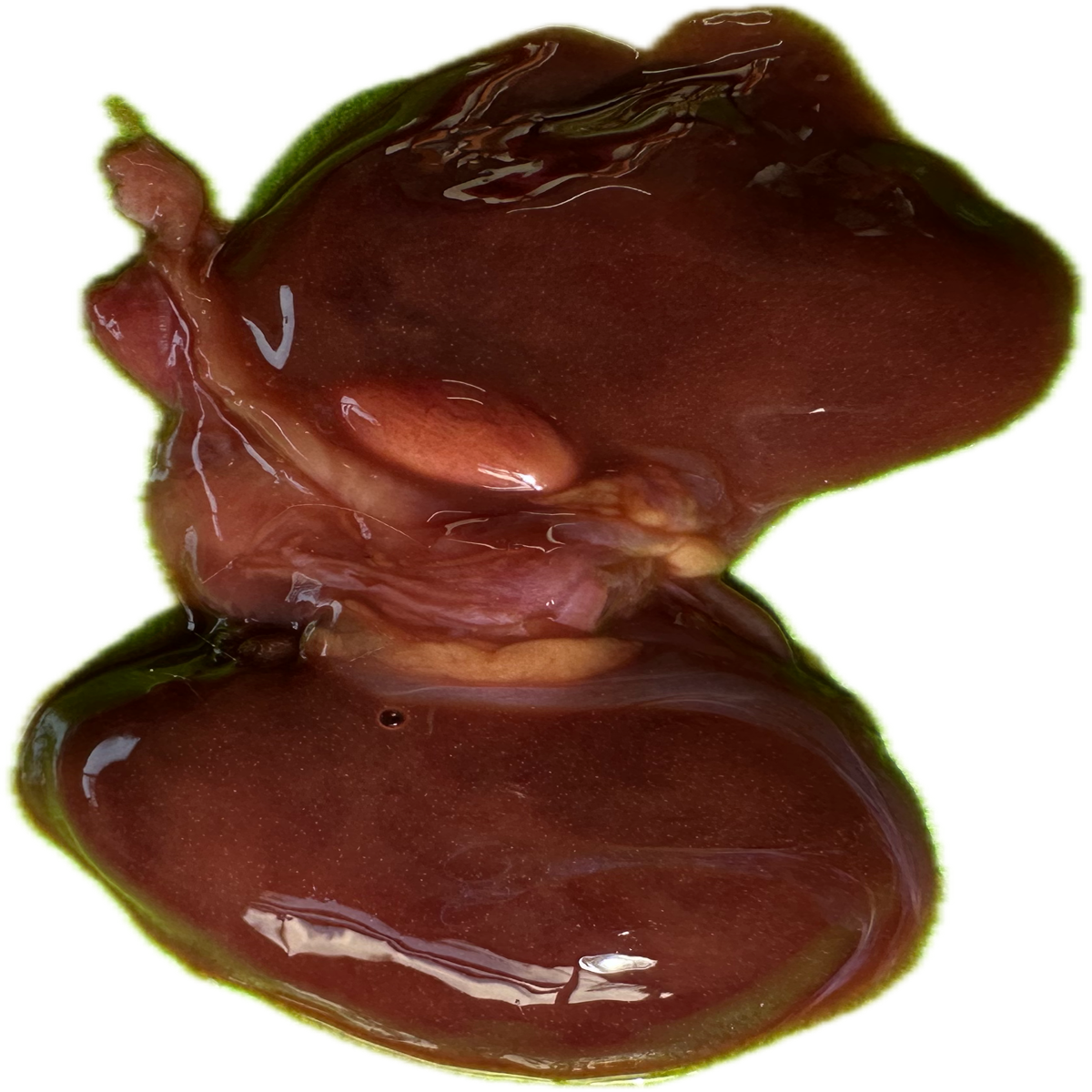 Patología Renal 2