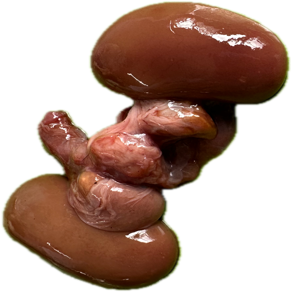 Patología Renal 3