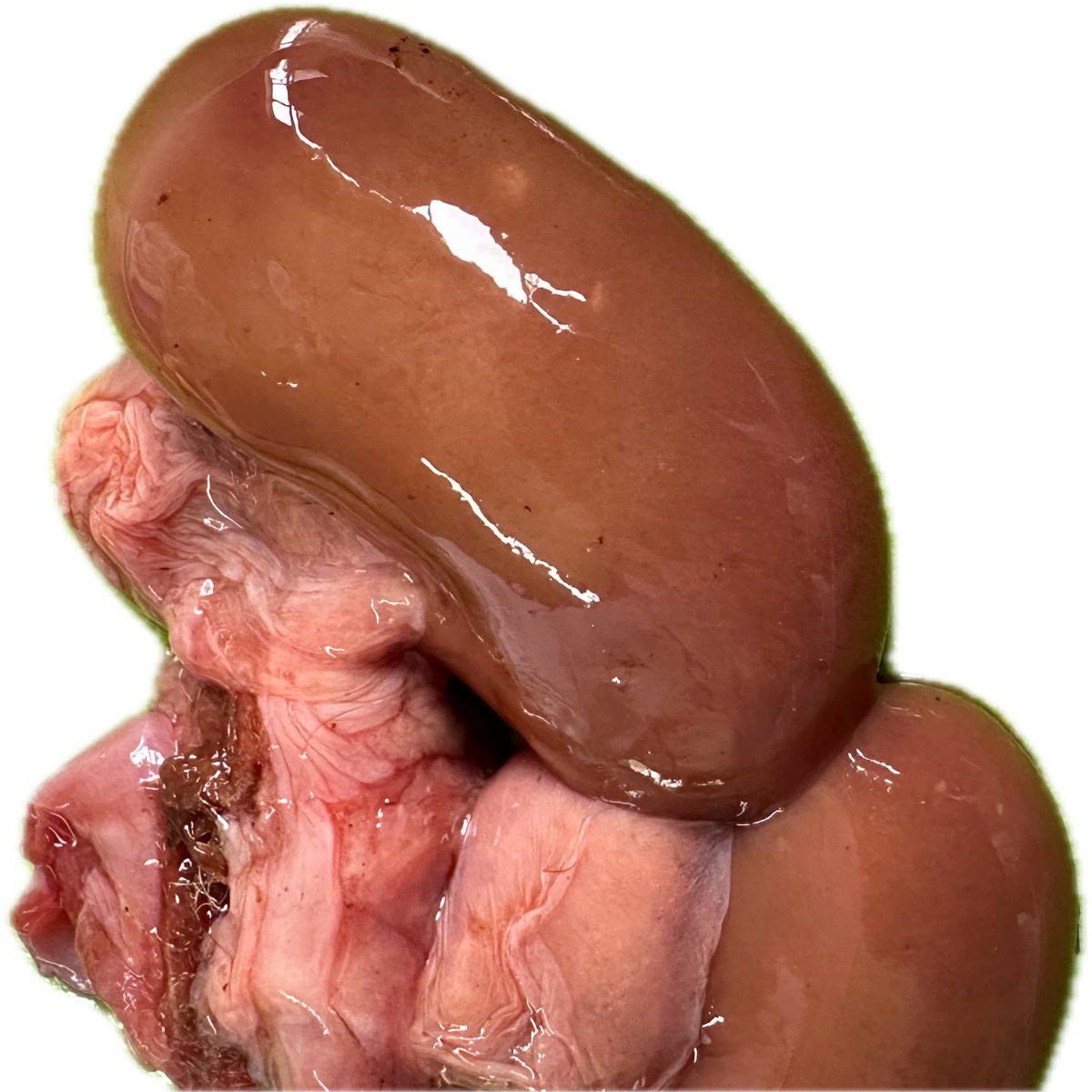 Patología Renal 4