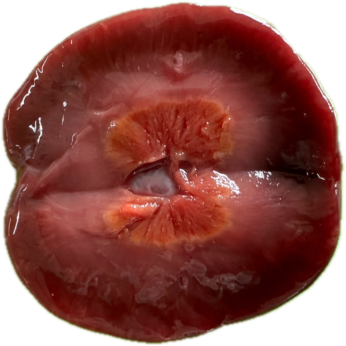 Patología Renal 5