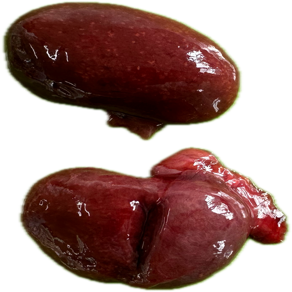Patología Renal 6