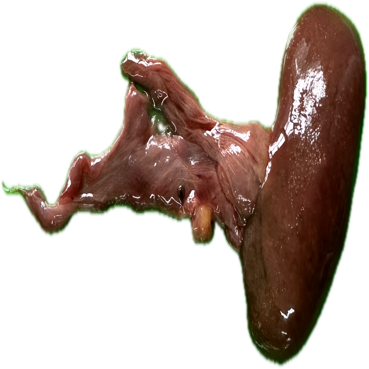 Patología Renal 7