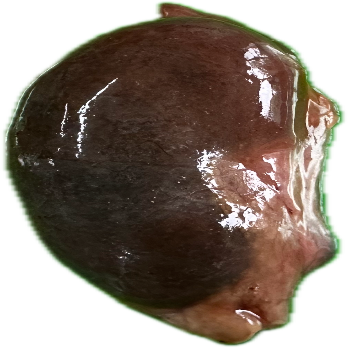 Patología Renal 8