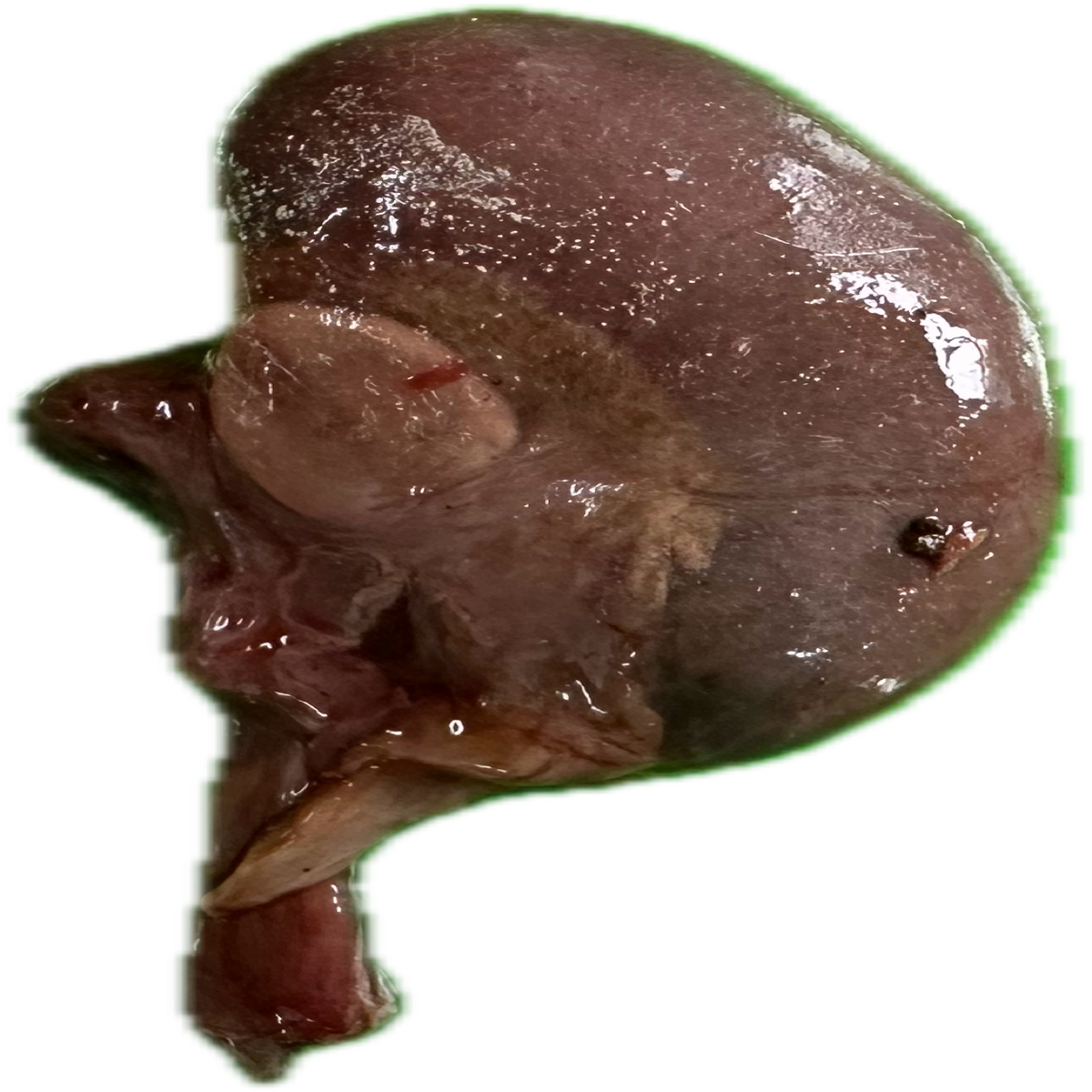 Patología Renal 9