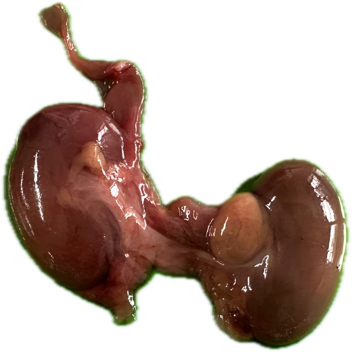 Patología Renal 10