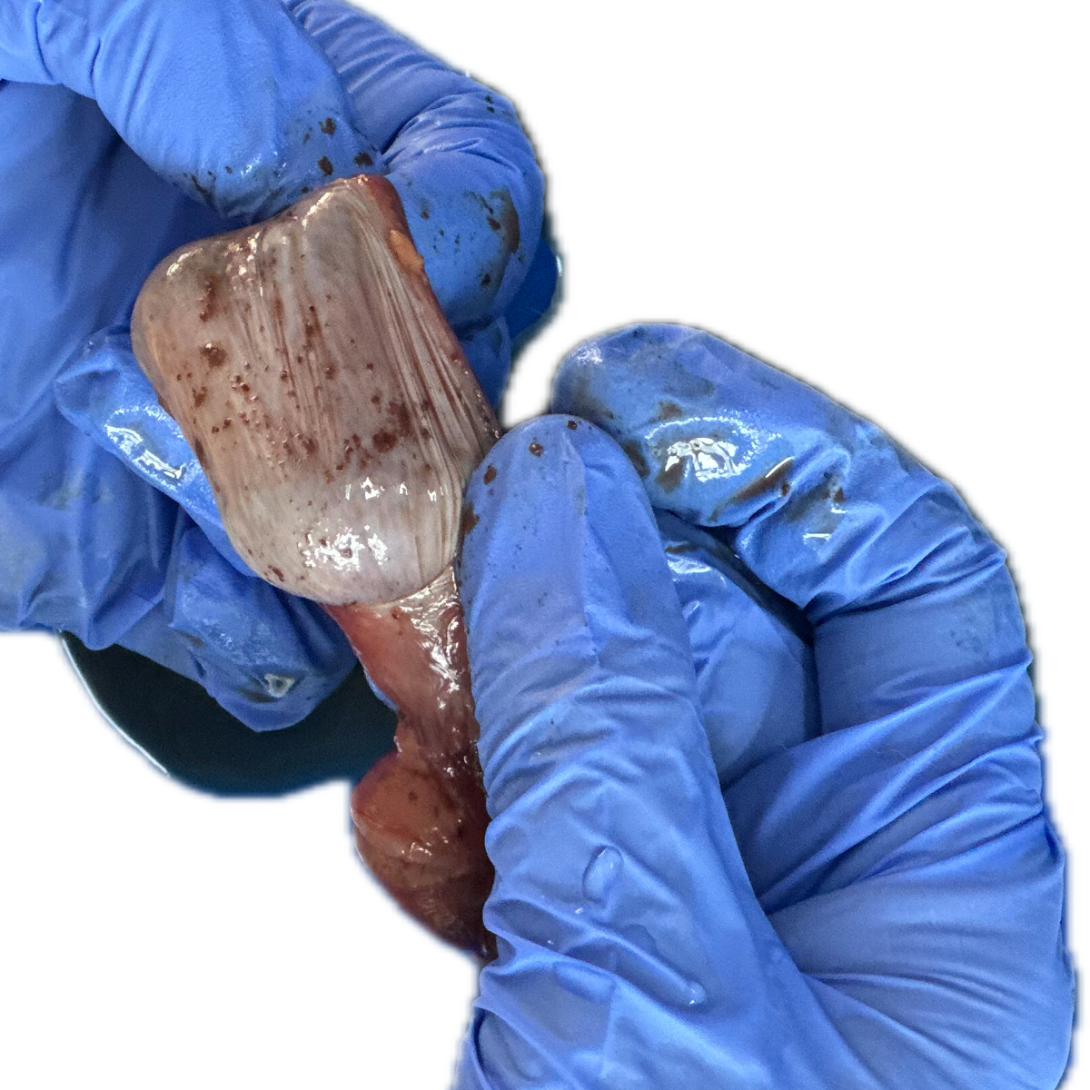Patología Vesical 1