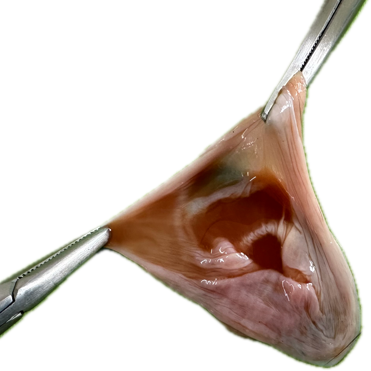 Patología Vesical 8