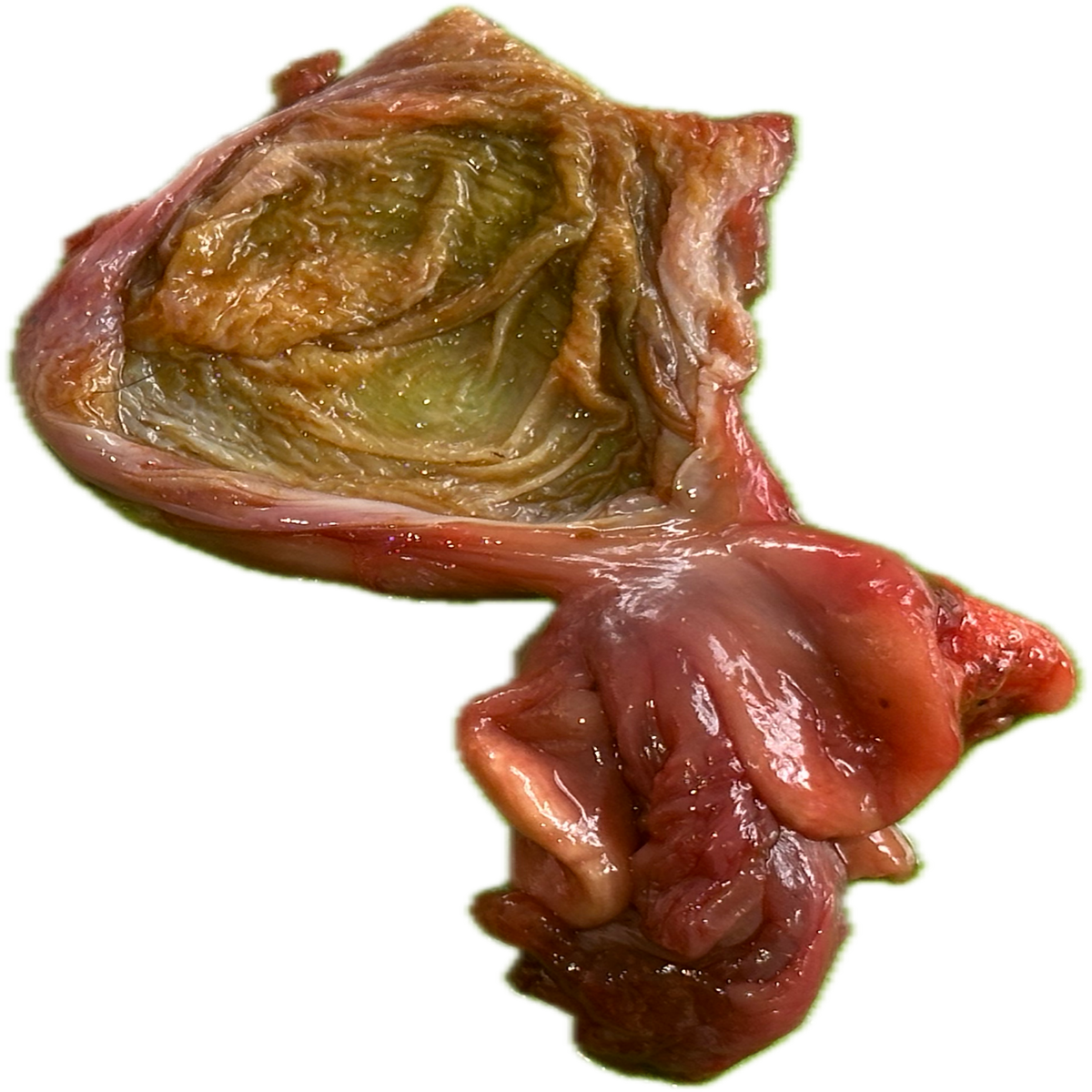 Patología Vesical 2